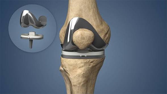Unlocking the Mysteries of Revision Total Knee Arthroplasty: What You Need to Know